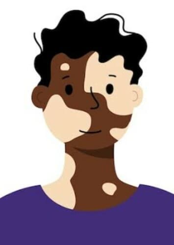Vitiligo (M)